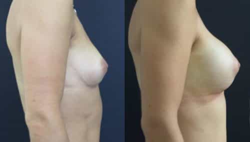 Breast Augmentation Colombia - Premium Care Plastic Surgery