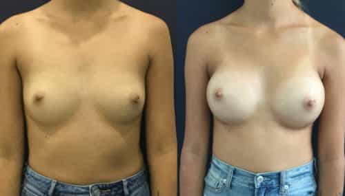 Breast Augmentation Colombia - Premium Care Plastic Surgery