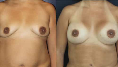 Breast Augmentation Colombia - Premium Care Plastic Surgery