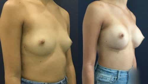 Breast Augmentation Colombia - Premium Care Plastic Surgery