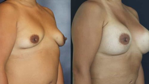 Breast Augmentation Colombia - Premium Care Plastic Surgery