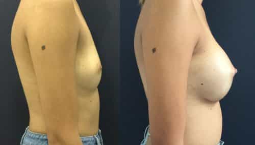 Breast Augmentation Colombia - Premium Care Plastic Surgery