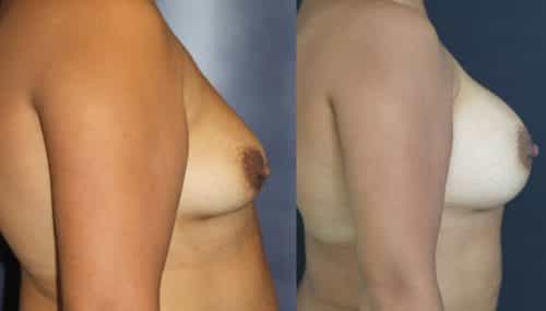 Breast Augmentation Colombia - Premium Care Plastic Surgery