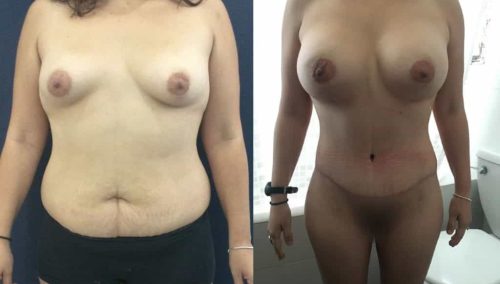 Breast Augmentation Colombia - Premium Care Plastic Surgery