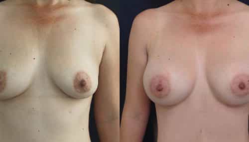 Breast Augmentation Colombia - Premium Care Plastic Surgery