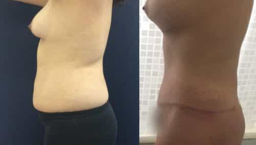 Breast Augmentation Colombia - Premium Care Plastic Surgery