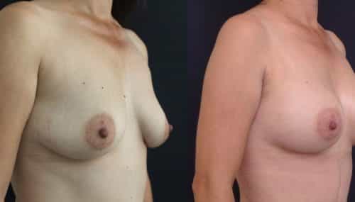 Breast Augmentation Colombia - Premium Care Plastic Surgery