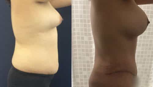 Breast Augmentation Colombia - Premium Care Plastic Surgery