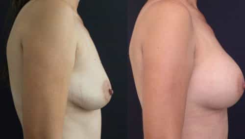 Breast Augmentation Colombia - Premium Care Plastic Surgery