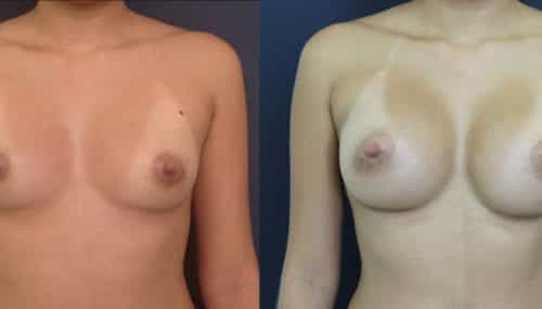 Breast Augmentation Colombia - Premium Care Plastic Surgery