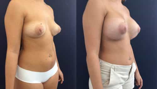 Breast Augmentation Colombia - Premium Care Plastic Surgery
