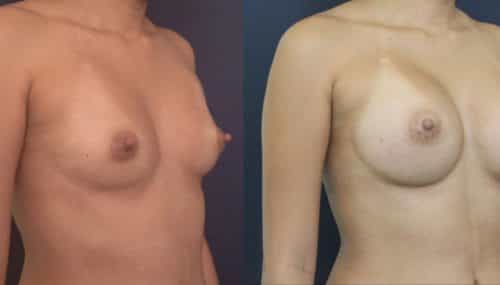 Breast Augmentation Colombia - Premium Care Plastic Surgery