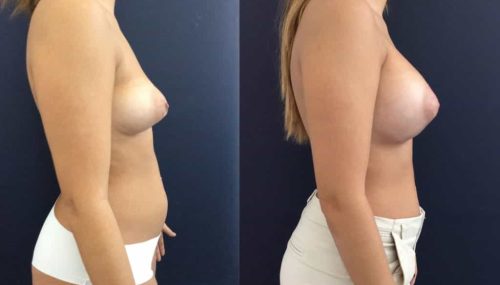 Breast Augmentation Colombia - Premium Care Plastic Surgery