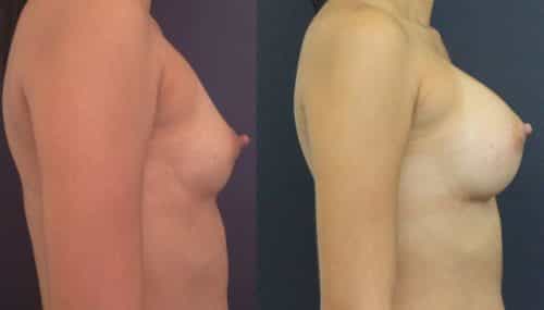 Breast Augmentation Colombia - Premium Care Plastic Surgery