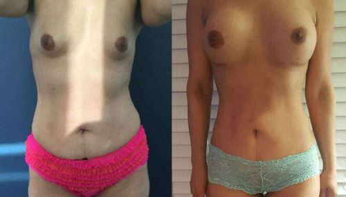 Breast Augmentation Colombia - Premium Care Plastic Surgery