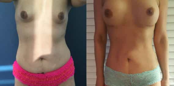 Breast Augmentation Colombia - Premium Care Plastic Surgery