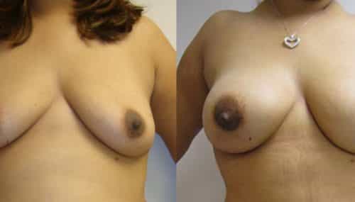 Breast Augmentation Colombia - Premium Care Plastic Surgery