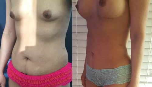 Breast Augmentation Colombia - Premium Care Plastic Surgery