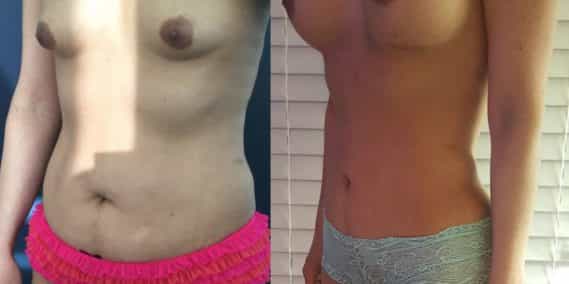 Breast Augmentation Colombia - Premium Care Plastic Surgery