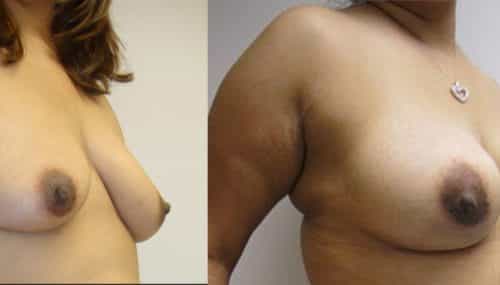 Breast Augmentation Colombia - Premium Care Plastic Surgery