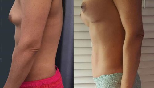 Breast Augmentation Colombia - Premium Care Plastic Surgery