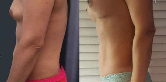 Breast Augmentation Colombia - Premium Care Plastic Surgery