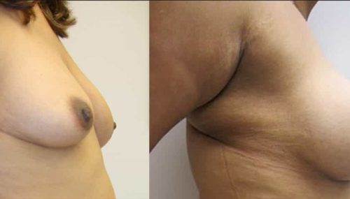 Breast Augmentation Colombia - Premium Care Plastic Surgery