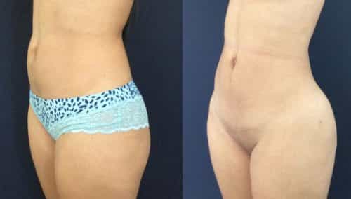 Brazilian Butt Lift Cartagena Colombia - Premium Care Plastic Surgery