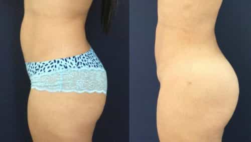 Before and After brazilian butt lift Colombia - Premium Care Plastic Surgery