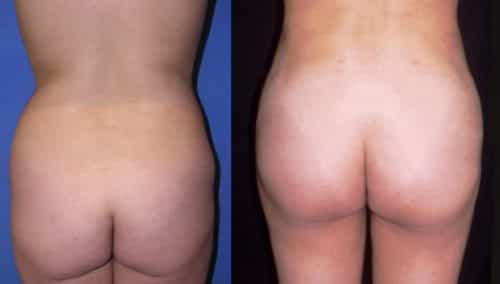 Before and After brazilian butt lift Colombia - Premium Care Plastic Surgery