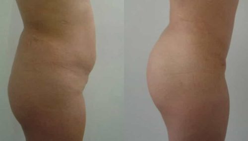 Brazilian Butt Lift Cartagena Colombia - Premium Care Plastic Surgery