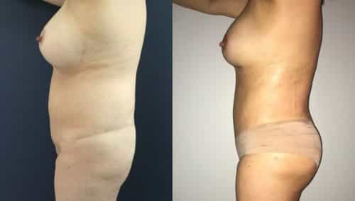 Before and after Breast Revision Colombia - Premium Care Plastic Surgery