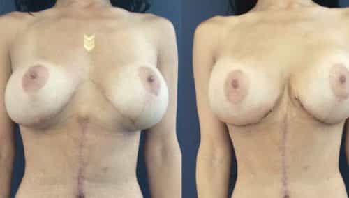 Before and after Breast Revision Colombia - Premium Care Plastic Surgery