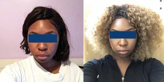 Before and After Buccal Fat Removal Colombia - Premium Care Plastic Surgery