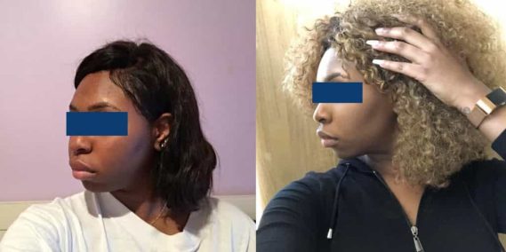 Before and After Buccal Fat Removal Colombia - Premium Care Plastic Surgery