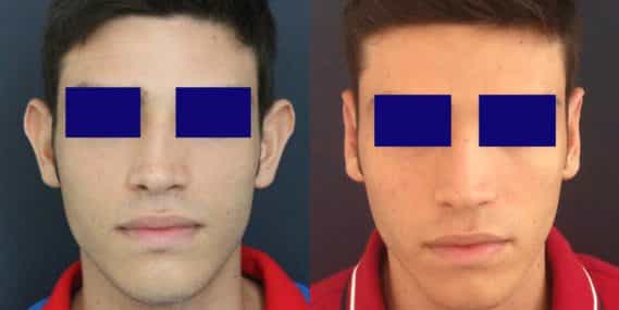 before and after Ear Surgery Colombia - Premium Care Plastic Surgery