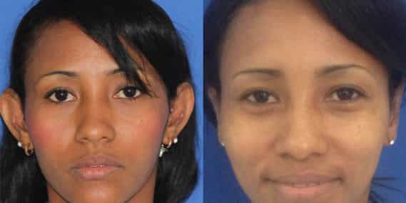 before and after Ear Surgery Colombia - Premium Care Plastic Surgery