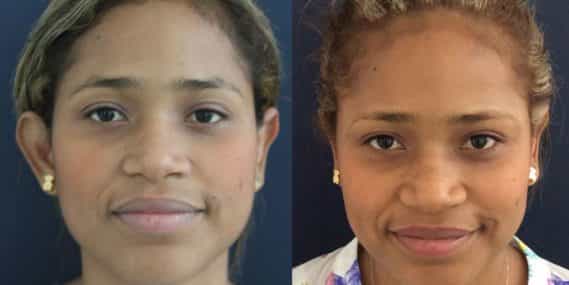 Ear Surgery Colombia - Premium Care Plastic Surgery