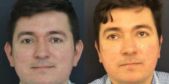 Ear Surgery Colombia - Premium Care Plastic Surgery