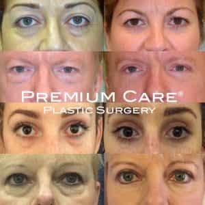 Eyelid Surgery in Colombia - Premium Care Plastic Surgery