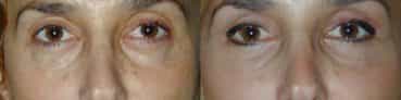 before and after Eyelid Surgery Colombia - Premium Care Plastic Surgery