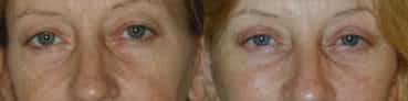before and after Eyelid Surgery Colombia - Premium Care Plastic Surgery