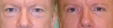 before and after Eyelid Surgery Colombia - Premium Care Plastic Surgery