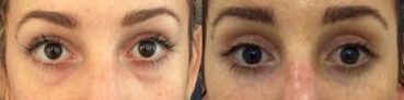 before and after Eyelid Surgery Colombia - Premium Care Plastic Surgery