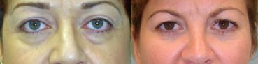 before and after Eyelid Surgery Colombia - Premium Care Plastic Surgery