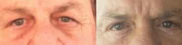 before and after Eyelid Surgery Colombia - Premium Care Plastic Surgery