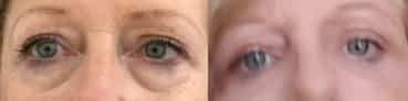 before and after Eyelid Surgery Colombia - Premium Care Plastic Surgery
