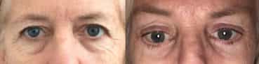 before and after Eyelid Surgery Colombia - Premium Care Plastic Surgery