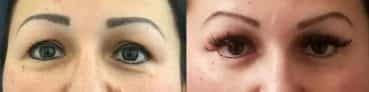 before and after Eyelid Surgery Colombia - Premium Care Plastic Surgery