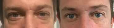 before and after Eyelid Surgery Colombia - Premium Care Plastic Surgery